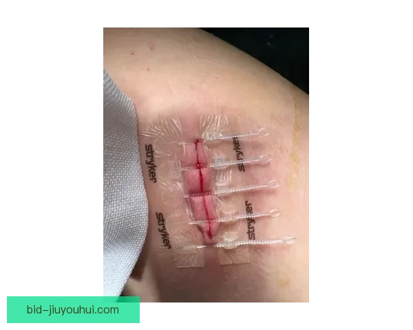 格罗索执教里昂遭球迷袭击面部受伤紧急缝针事件引关注